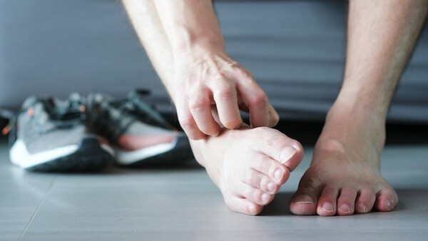 여름에 전염성 강한 무좀, 발수건·슬리퍼 따로 써야